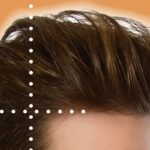 how does hair transplant work