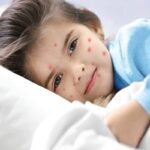 How To Get Rid Of Chickenpox