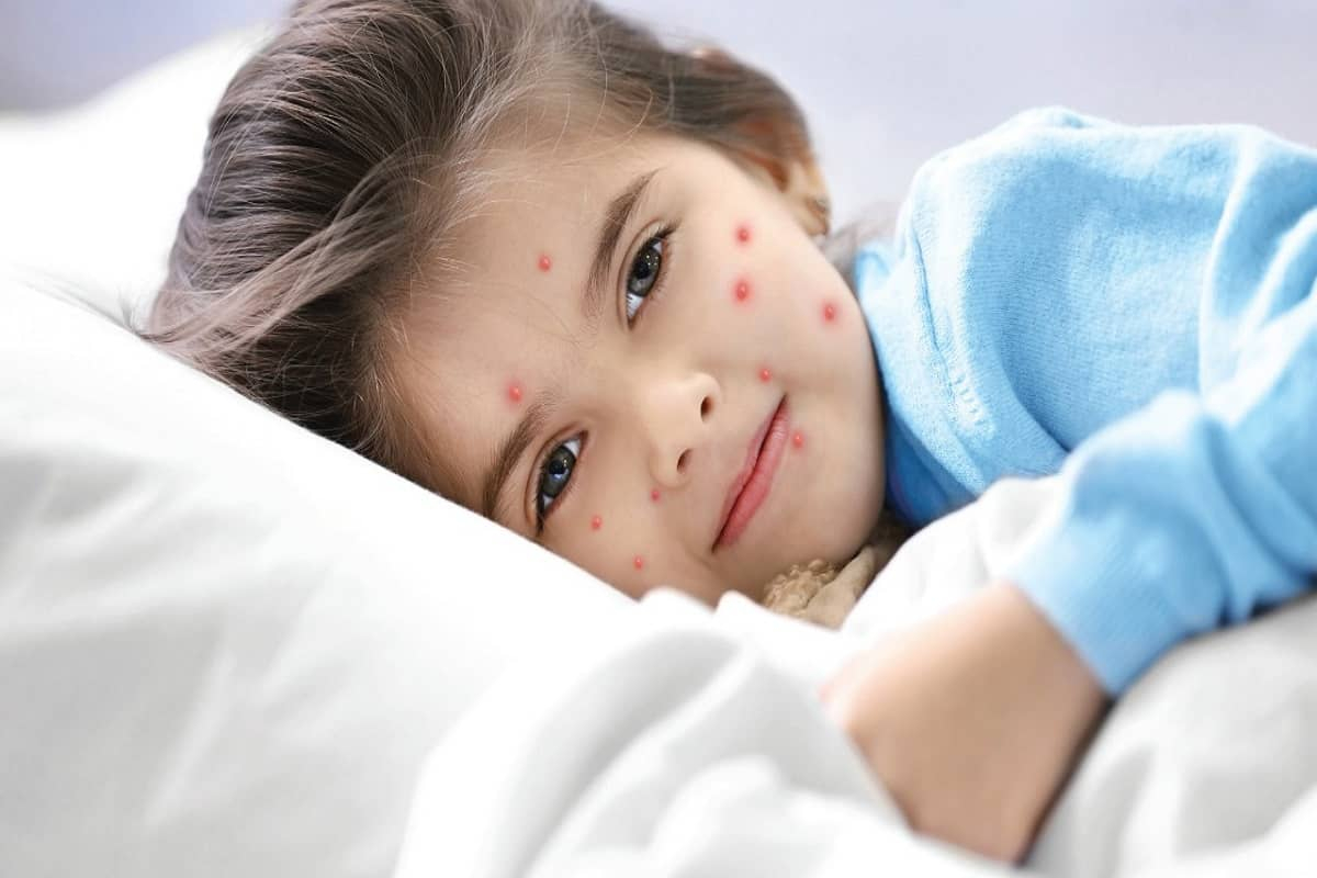 How To Get Rid Of Chickenpox