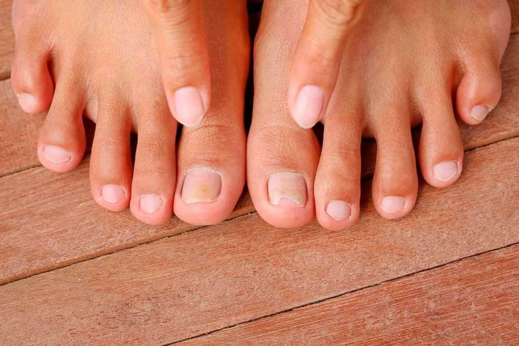 One Cup of This Will Destroy Your Nail Fungus