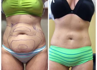 Liposuction Basics