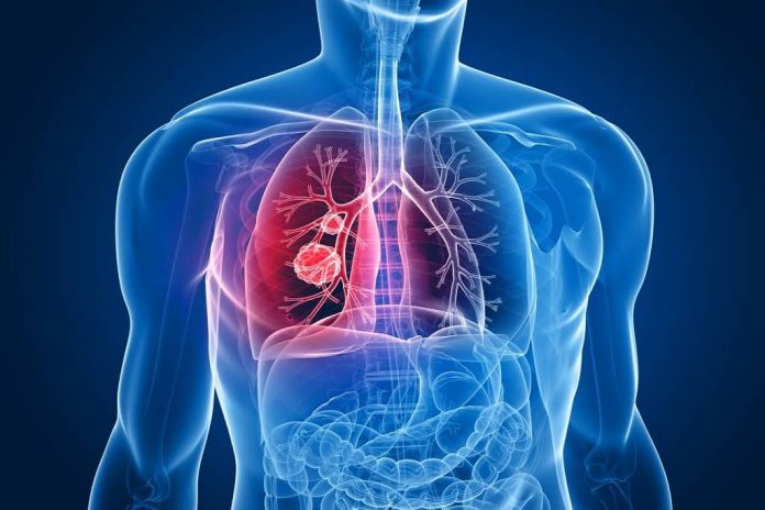 Mesothelioma Cancer