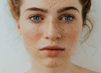 sunspots on skin treatment